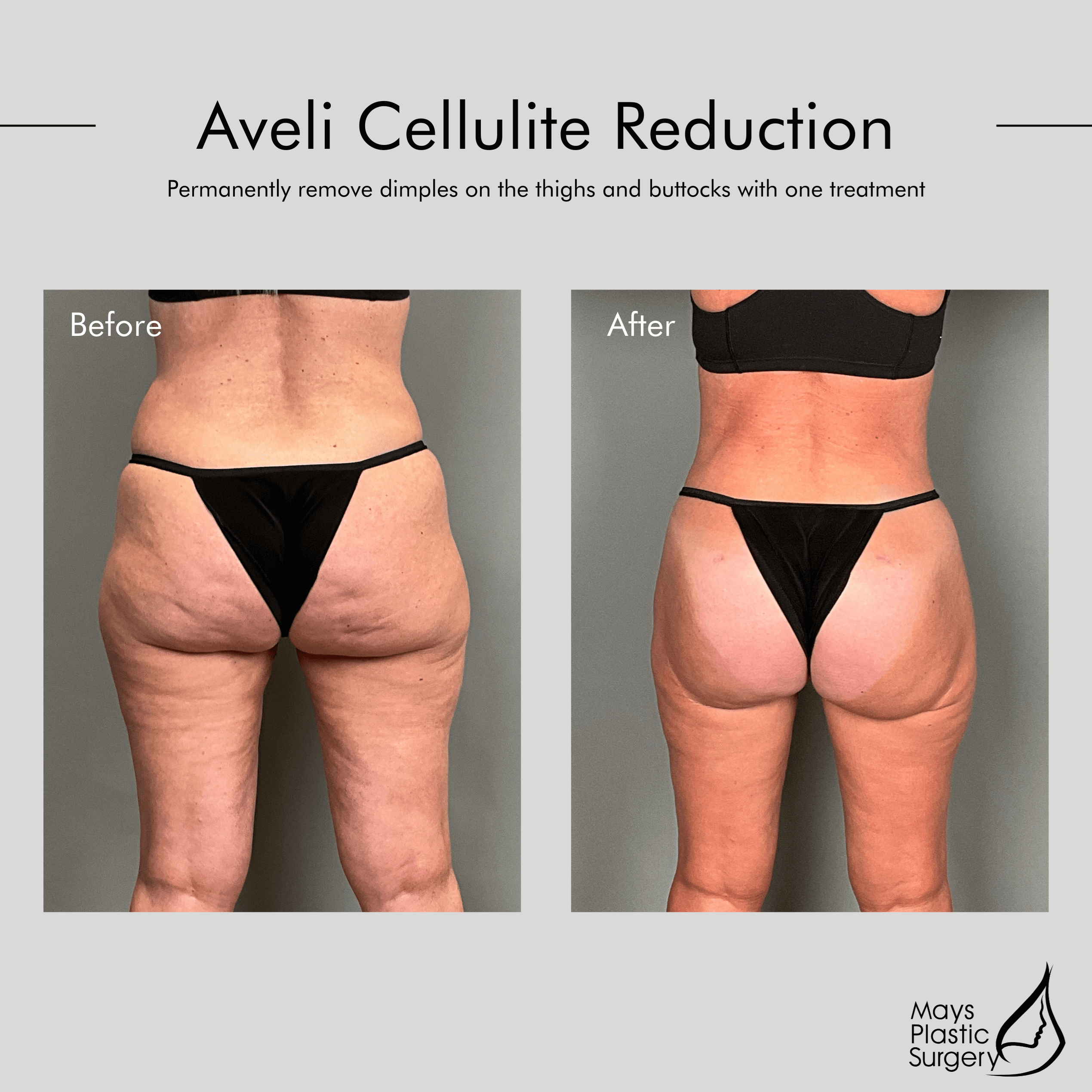 Aveli Cellulite Reduction at M